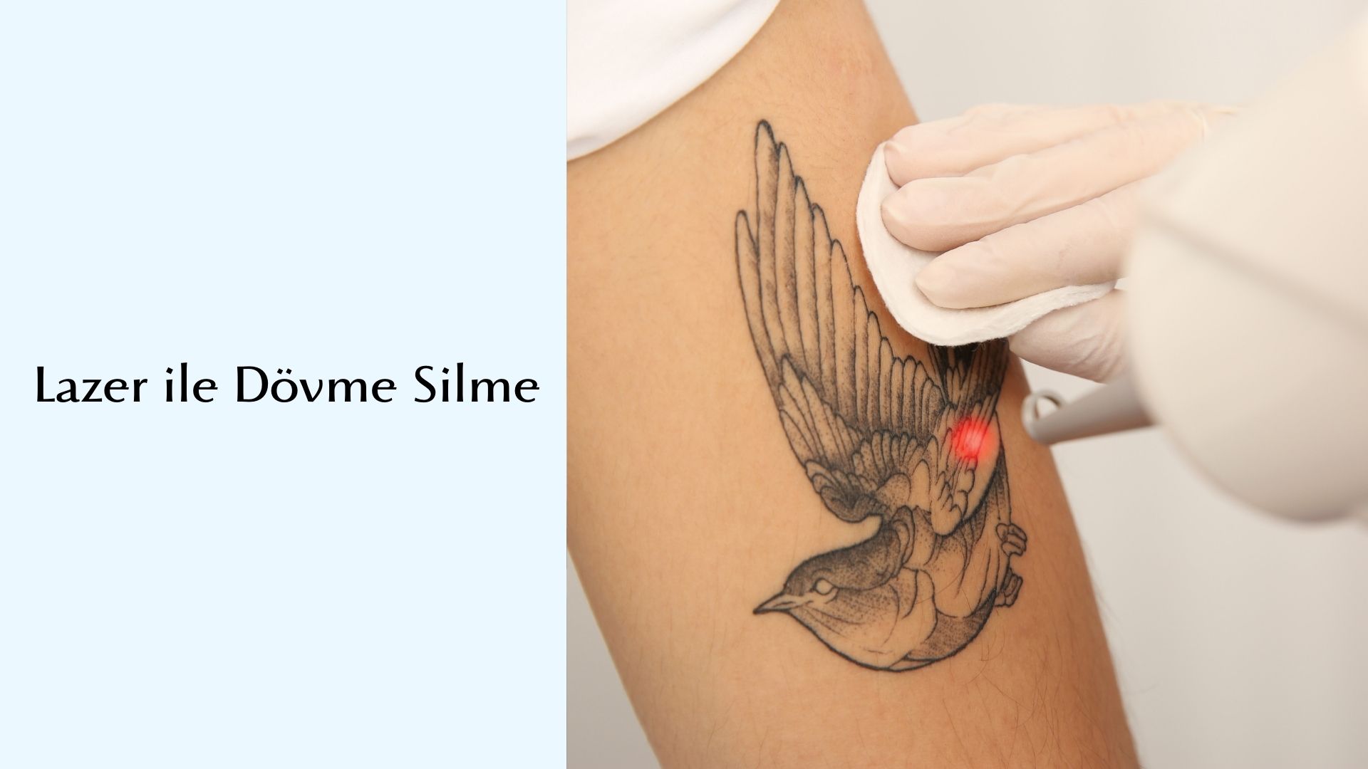 Lazer İle Dövme Silme 