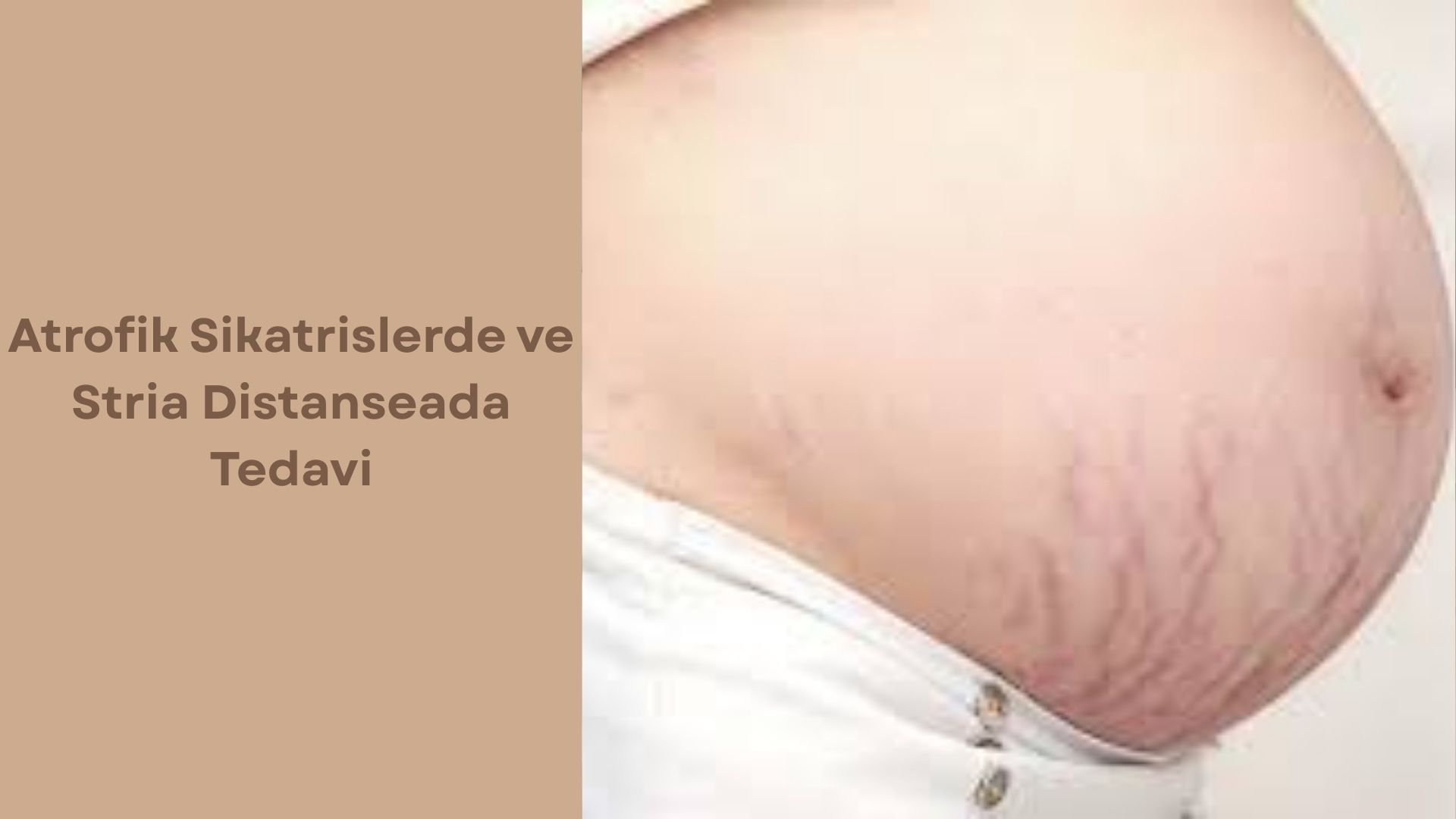 Atrofik Sikatrislerde ve Stria Distanseada Tedavi