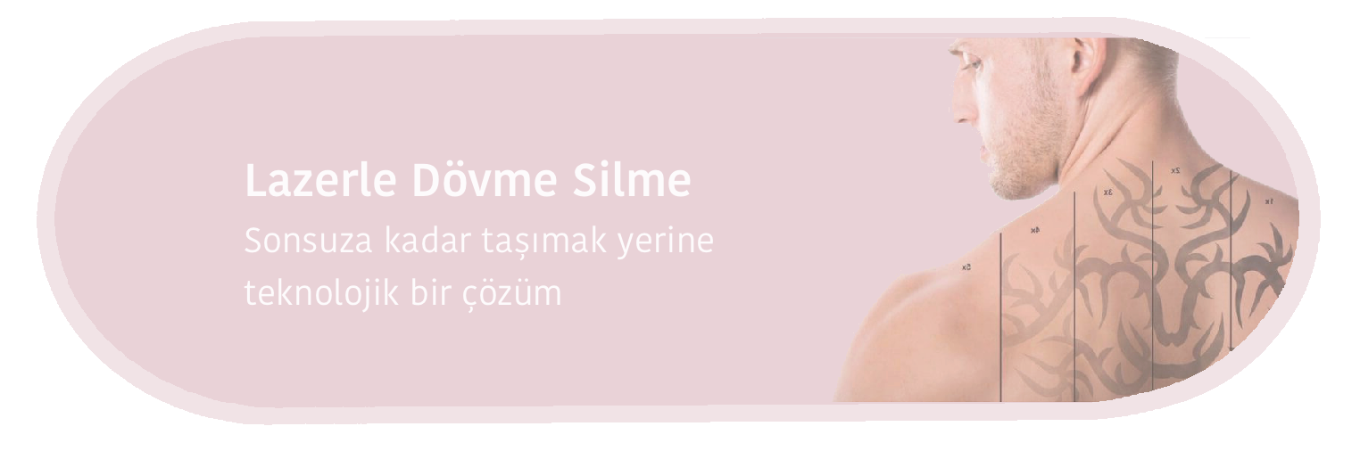 lazerle-dovme-silme