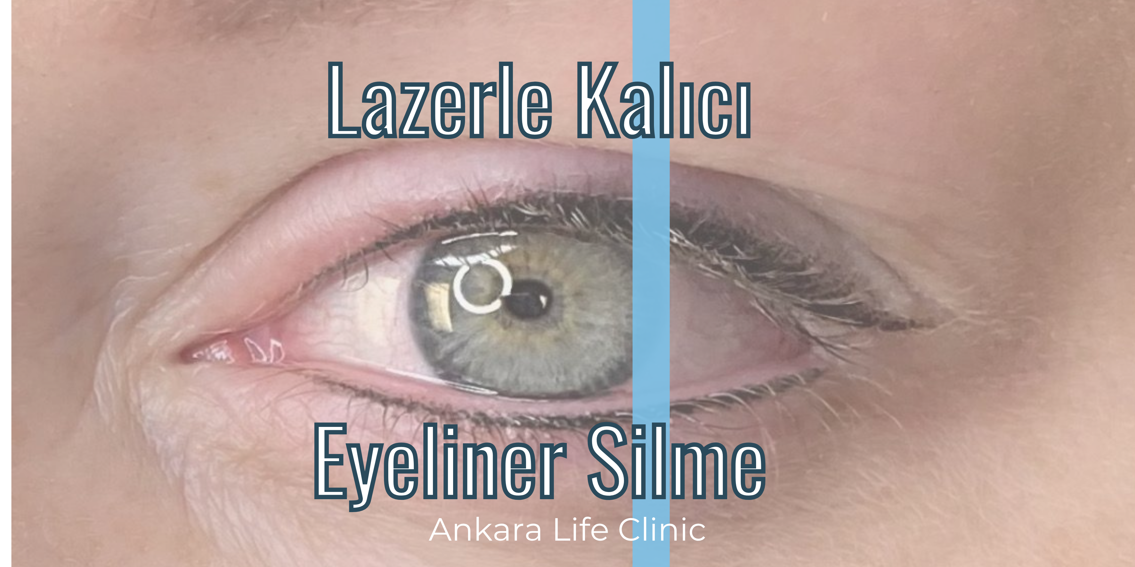sivilce